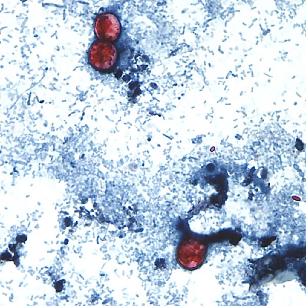Federal Probe Continues Into Cyclospora Lettuce Outbreak